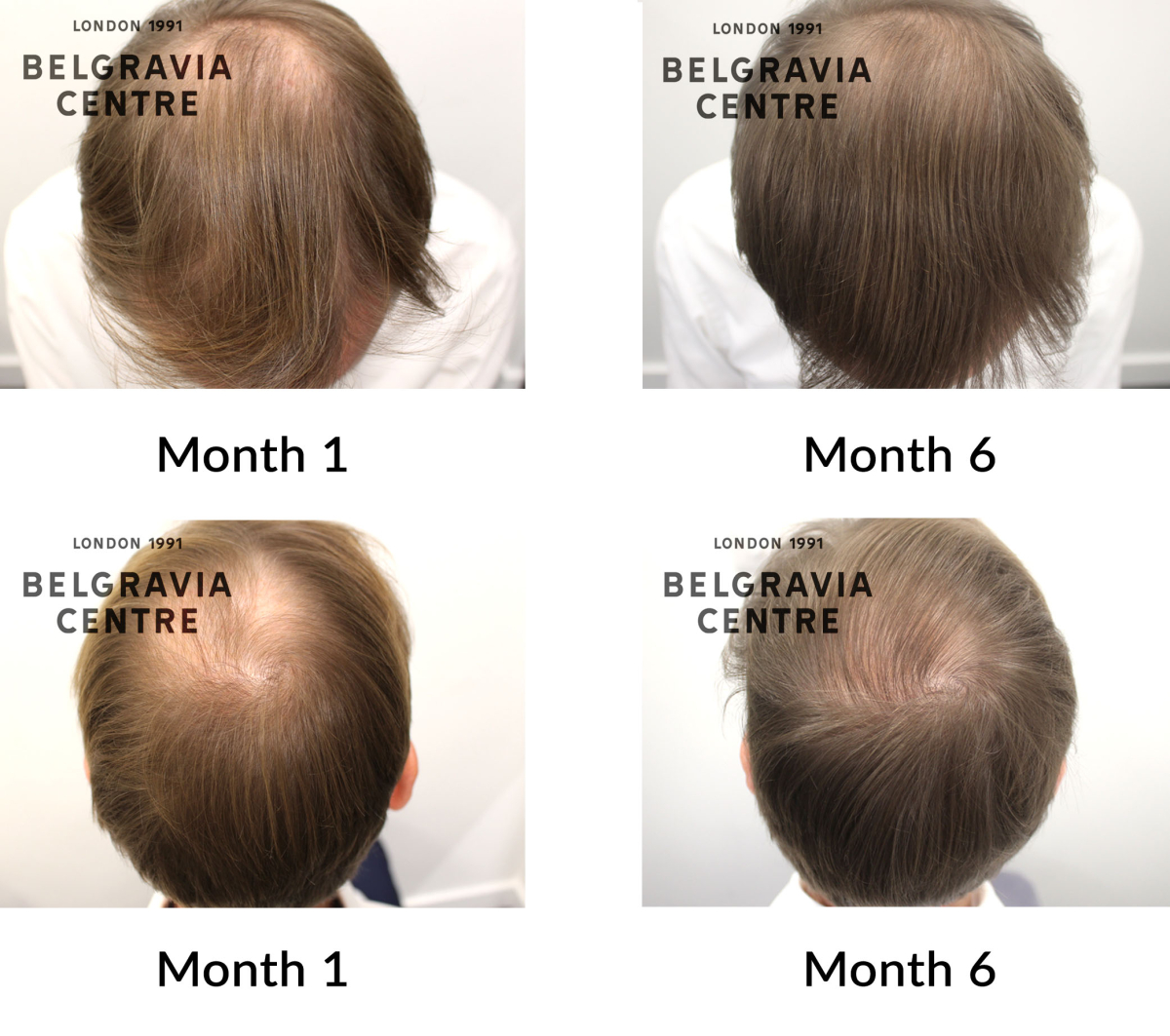 male pattern hair loss the belgravia centre 446089