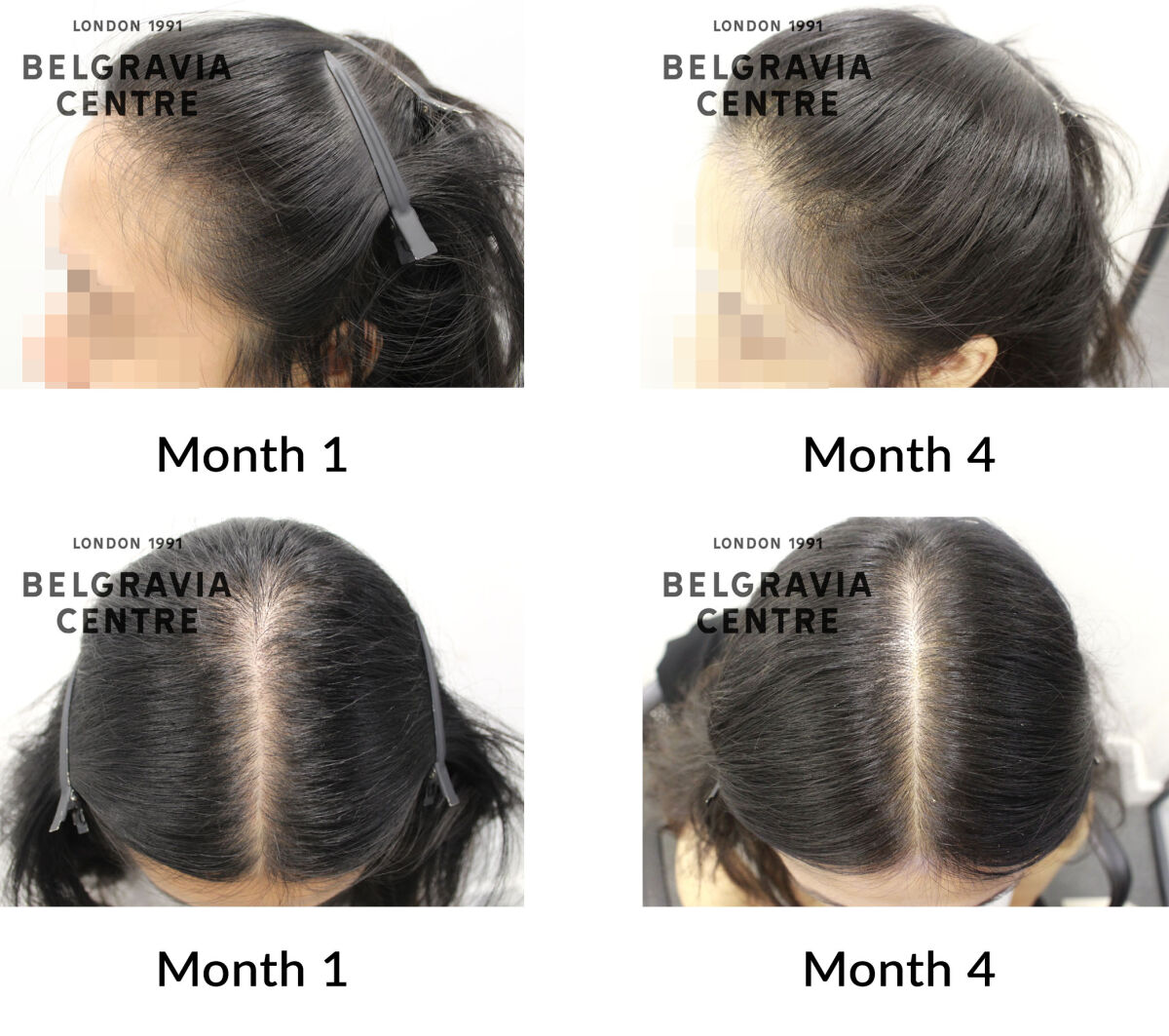 female pattern hair loss the belgravia centre 440798