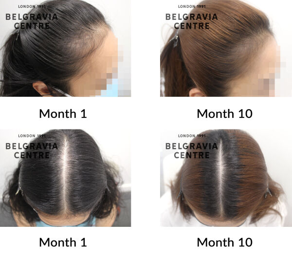 female pattern hair loss the belgravia centre 128669