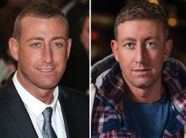Christopher Maloney Says X Factor Caused Hair Loss Had Three Hair Transplants to Fix Receding Hairline