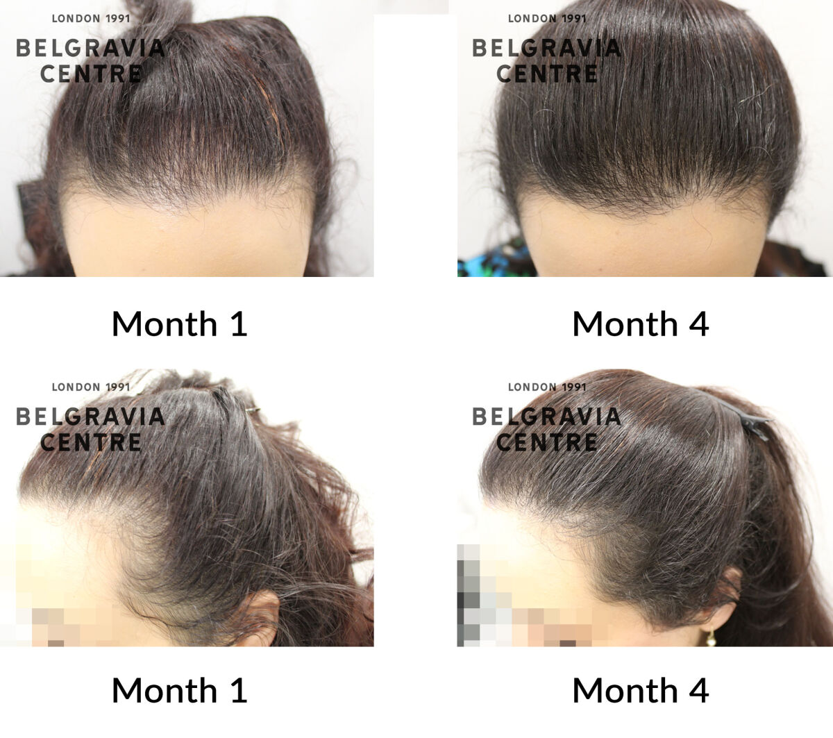 female pattern hair loss the belgravia centre 450532