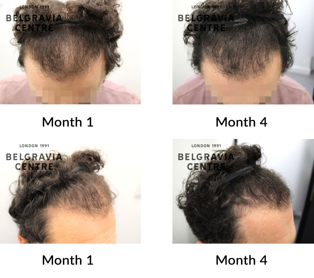 male pattern hair loss the belgravia centre  450127