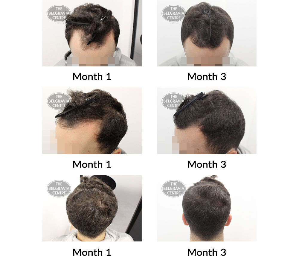 male pattern hair loss the belgravia centre 424787 08 10 2021