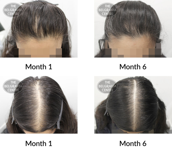 female pattern hair loss the belgravia centre 397493 11 09 2020