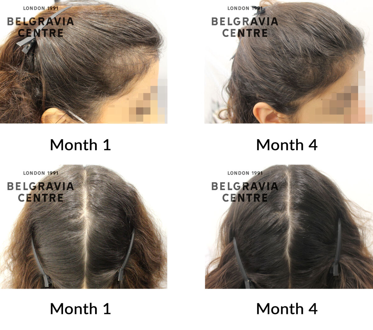 diffuse thinning and female pattern hair loss the belgravia centre 435195