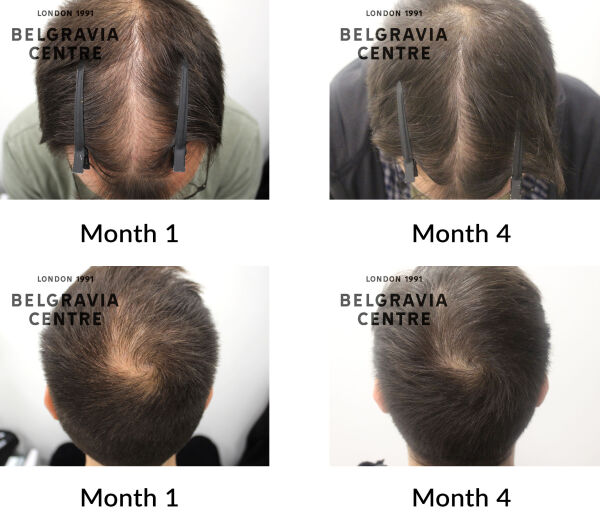 male pattern hair loss the belgravia centre 446582