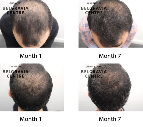 male pattern hair loss the belgravia centre 426313
