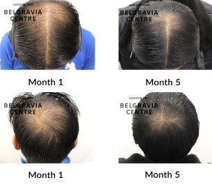 male pattern hair loss the belgravia centre 464270