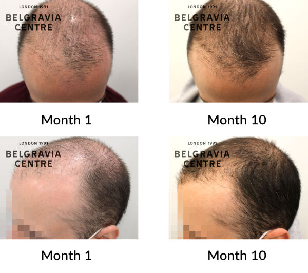 male pattern hair loss the belgravia centre 426578