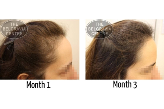 Diffuse Hair Loss Treated at The Belgravia Centre Hair Loss Clinic1