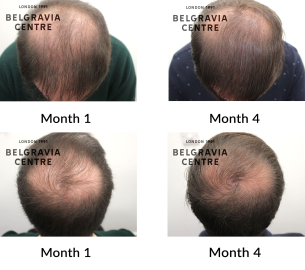 male pattern hair loss the belgravia centre 358981