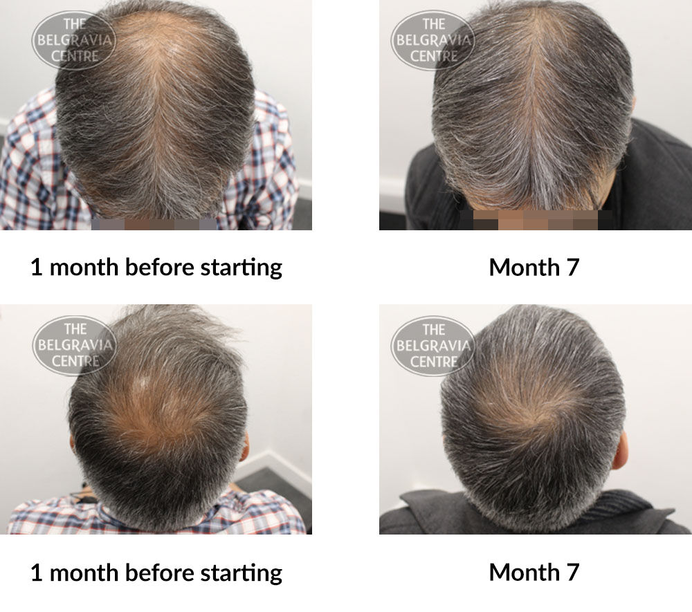 male pattern hair loss the belgravia centre 384326 15 07 2020