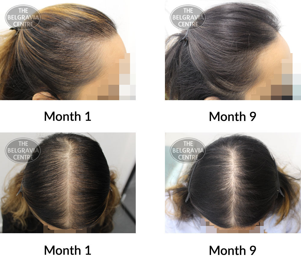 female pattern hair loss and diffuse hair loss the belgravia centre 406737 01 06 2021