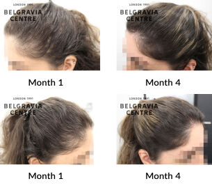 female pattern hair loss the belgravia centre 443532