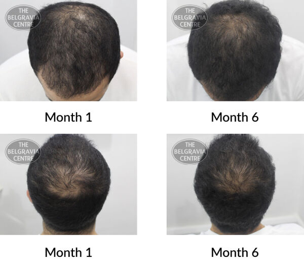 male pattern hair loss the belgravia centre 396380 04 08 2020
