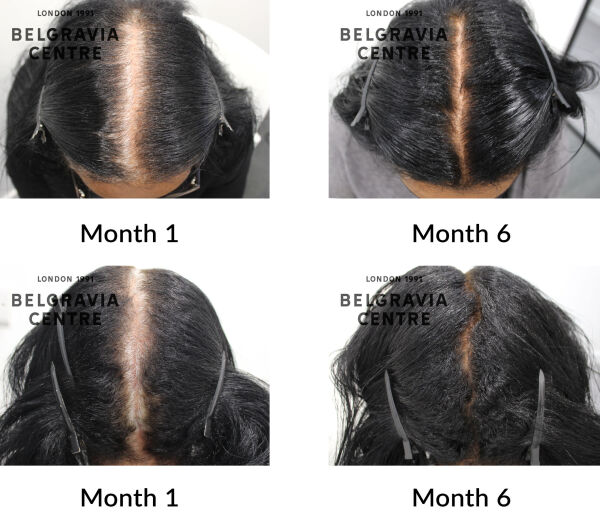 hair breakage, female pattern hair loss and diffuse hair loss the belgravia centre 19681