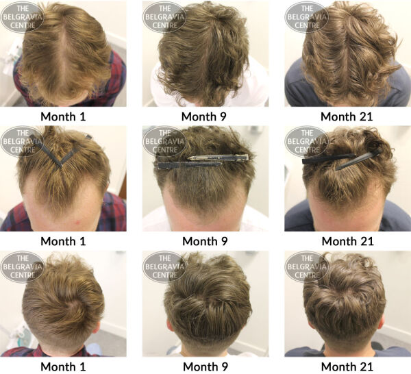 male pattern hair loss the belgravia centre sr 19 12 2018