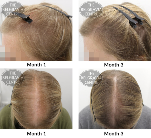 female pattern hair loss the belgravia centre HF 22 01 2019 2