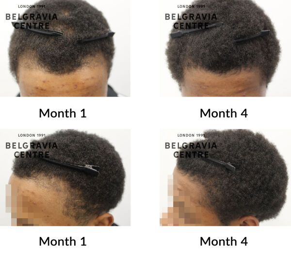 male pattern hair loss the belgravia centre 442463