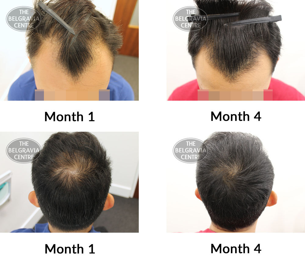male pattern hair loss the belgravia centre 386777 18 11 2019