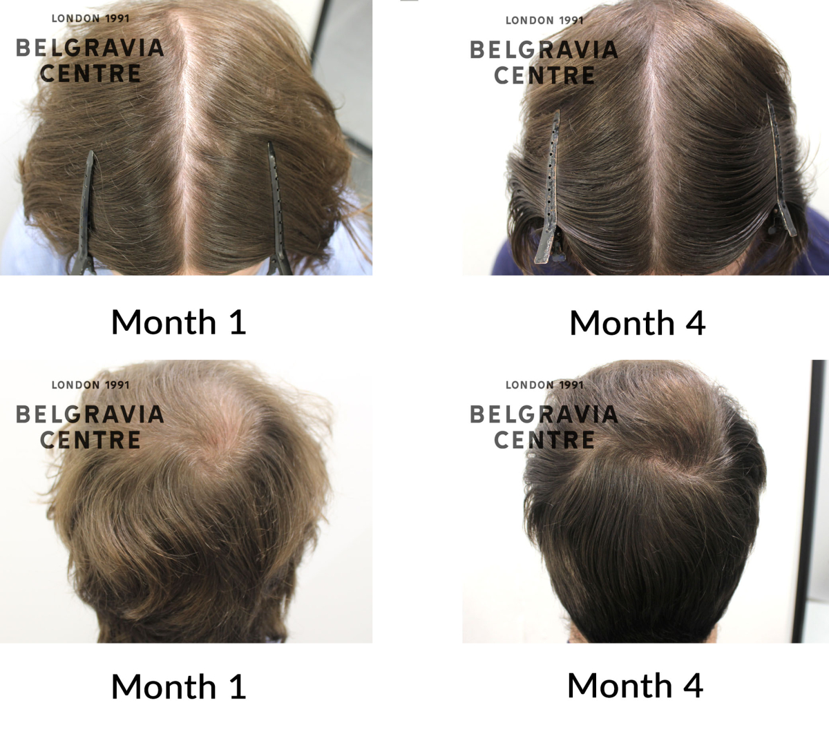 male pattern hair loss the belgravia centre 465600