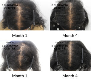 diffuse hair loss the belgravia centre 436708