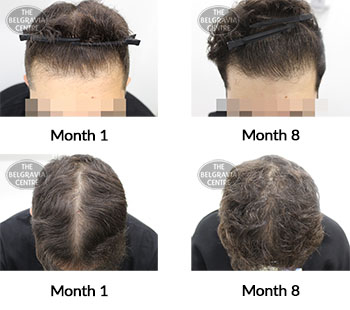 alert male pattern hair loss the belgravia centre 411321 25 06 2021