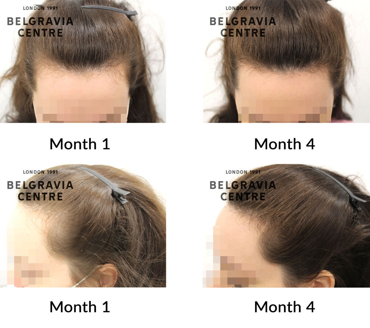 female pattern hair loss the belgravia centre 434284