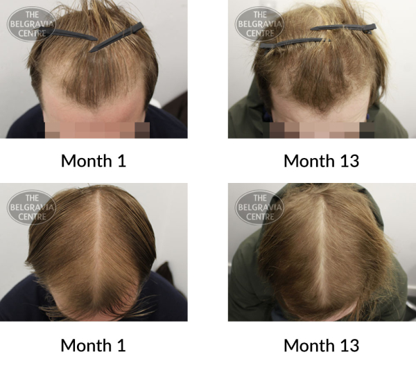 male pattern hair loss the belgravia centre 393616 14 01 2021
