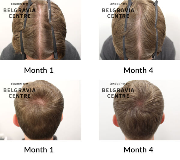 male pattern hair loss the belgravia centre 438761