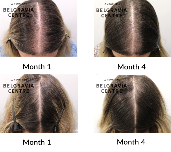 female pattern hair loss the belgravia centre 461392