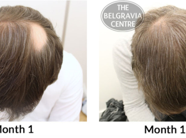 Alopecia Areata Treatment Success Story Michal