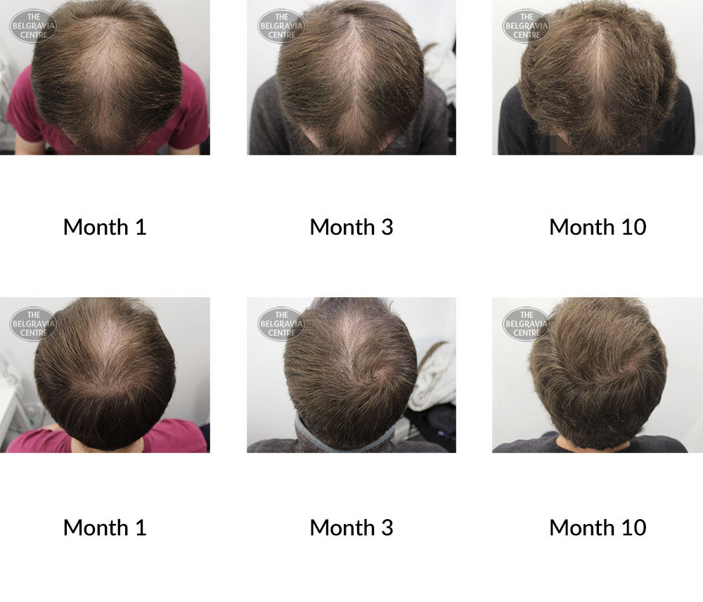 male pattern hair loss the belgravia centre 392820 10 09 2020
