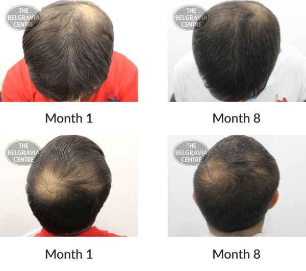 male pattern hair loss the belgravia centre 397416 15 10 2020