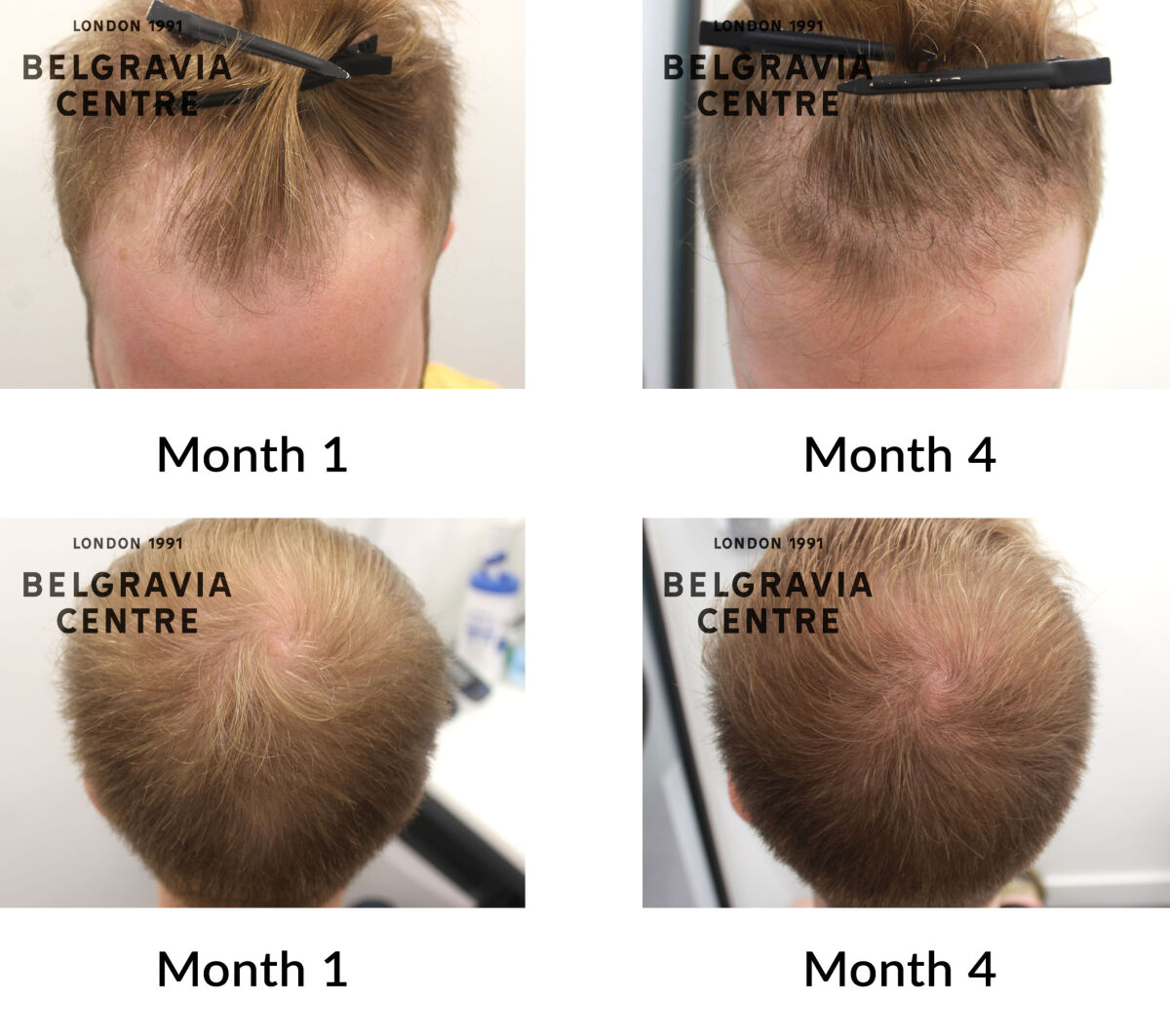 male pattern hair loss the belgravia centre 440592