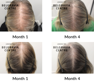 female pattern hair loss the belgravia cenyre 448228