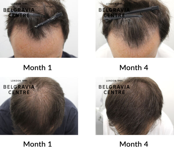 male pattern hair loss the belgravia centre 439295