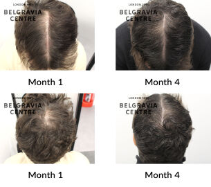 male pattern hair loss the belgravia centre 433399