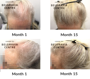 female pattern hair loss the belgravia centre 450197