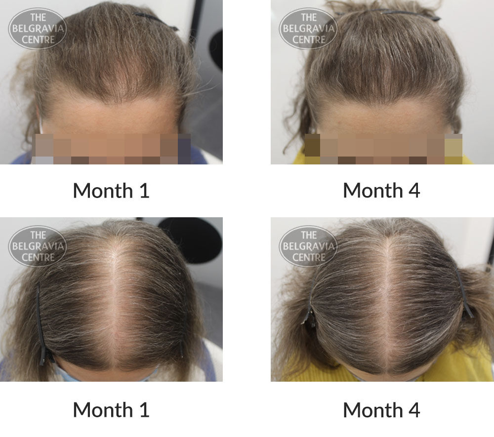 female pattern hair loss the belgravia centre 403948 05 11 2020