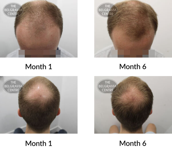 male pattern hair loss the belgravia centre 395392 17 08 2020