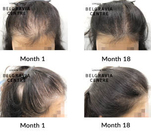 female pattern hair loss the belgravia centre 446387
