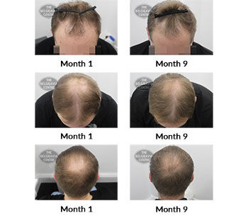 alert male pattern hair loss the belgravia centre 413298 27 09 2021