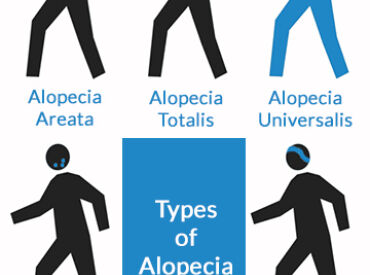 Diagram Belgravia Centre Different Types of Alopecia Areata autoimmune hair loss