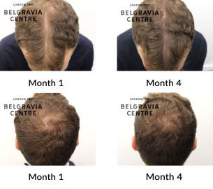 male pattern hair loss the belgravia centre 452707