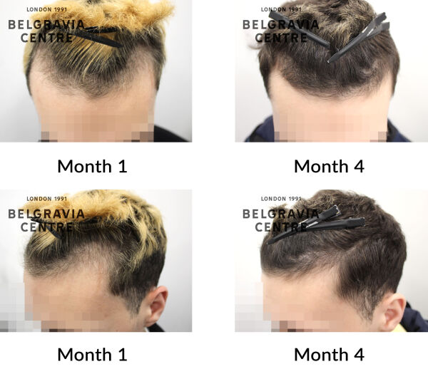 male pattern hair loss the belgravia centre 448665