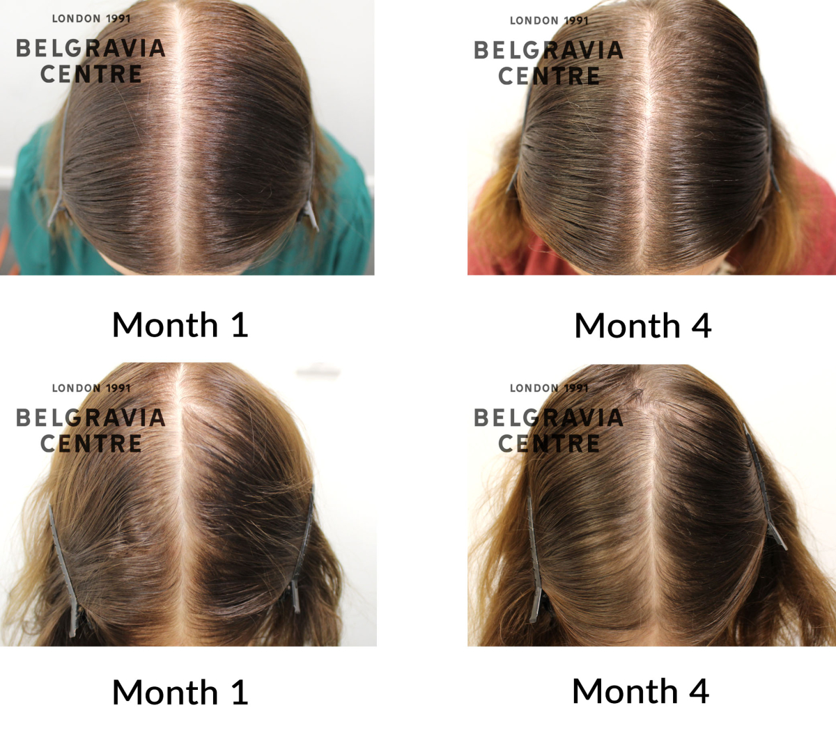 female pattern hair loss and diffuse hair loss the belgravia centre 460563