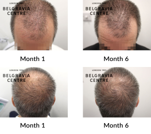 male pattern hair loss the belgravia centre 446316