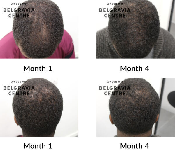 male pattern hair loss the belgravia centre 445392
