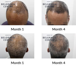 male pattern hair loss the belgravia centre 429461 211221
